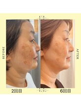 ニコホリ(NIKOHORI)/エクソリフト/フェイシャル/美肌