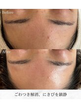 シロ(silo)/気になるニキビをケア