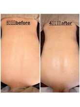 ミニョン(mignon)/夏前に見えない背中のお手入れを