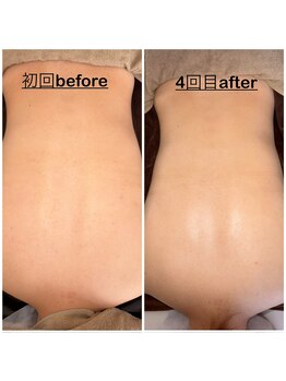 ミニョン(mignon)/夏前に見えない背中のお手入れを