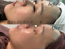 アンドナイン エス店(ANDNINE.)/ハーブピーリングでハリツヤup