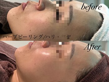 アンドナイン エス店(ANDNINE.)/ハーブピーリングでハリツヤup