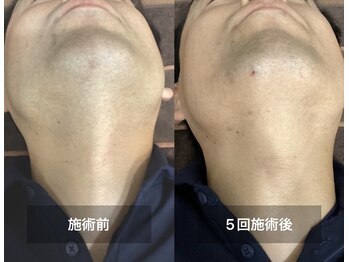 リリー(RILY)/【ビフォーアフター】