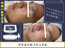 結果重視のフェイシャル◎プラズマで人生史上最高美肌へ！