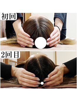 オステオデイジー(OsteoDaisy)/頭が小さく頭痛も軽減へ