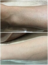 モット いこらもーる泉佐野店(mot)/脚フル脱毛