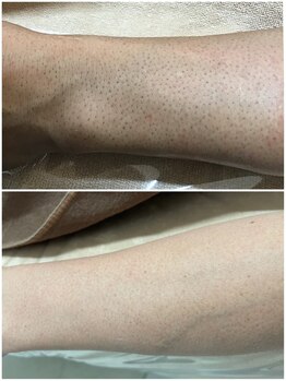 モット いこらもーる泉佐野店(mot)/脚フル脱毛