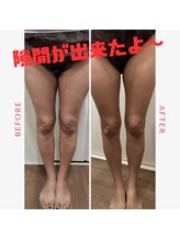 ココノワ(coconoix)/脂肪冷却&キャビテーション