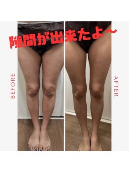 ココノワ(coconoix)/脂肪冷却&キャビテーション