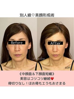 アンジェリカ(Angelica)/人中短く！下顔面タイトに★