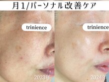 トリニエンス 新宿店(TRINIENCE)/50代/シミケア/パーソナルケア