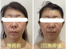 マーガレット整体/微弱電流フェイシャルの施術前後