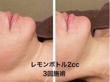 フィオーレ(Fiore)/レモンボトル