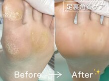 ディオフット(DIO FOOT)/【大人気】タコ/魚の目の除去★