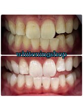 ホワイトニングショップ 大阪玉造店/Before&After美白ホワイトニング
