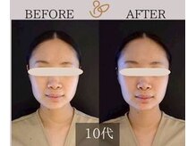 チョコバリ 新宿店(chocobari)/小顔×リフトアップ(美容鍼)10代