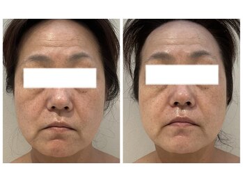 ラディアンス/小顔たるみ特化