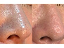 ミハン ボーテ(mihan.beaute)の雰囲気（【黒ずみ・毛穴つまり】バクチオールピール+毛穴洗浄　）