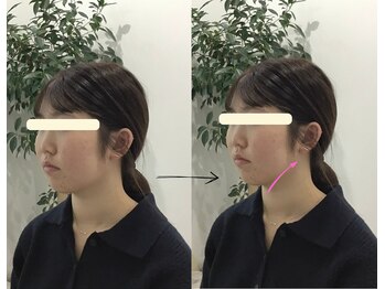 エール シガ(AILE SHIGA)の写真/【たるみ顔卒業!】鏡を見るたび気になるたるみ・・今こそ本気の引き締まった小顔矯正◆初回2,980/南草津