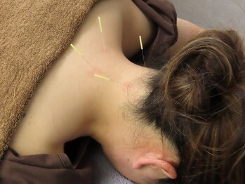 はり灸治療院 えがおの写真/【肩、腰、背中の辛さに】もう我慢しない！深部から緩める鍼で、毎日を笑顔に