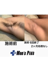 メンズプラス(Men's Plus)/ワキ脱毛★