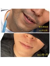 エニー(Any)/ひげ脱毛