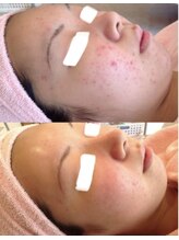 ノルン(Norn)/ニキビケア☆ハーブピーリング