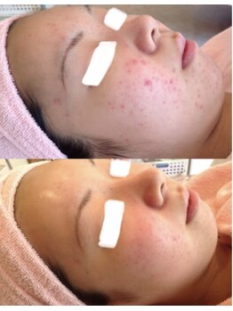 ノルン(Norn)/ニキビケア☆ハーブピーリング