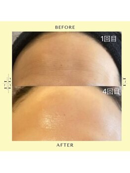 ニコホリ(NIKOHORI)/エクソリフト/フェイシャル/美肌