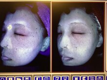 ポレポレ 八尾(polepole.)/ADS フェイシャルとホームケア