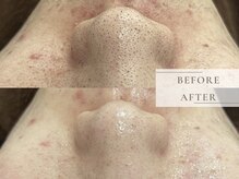 レヴィア(Revia)/ハーブ&毛穴洗浄1回でこの結果！