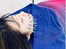 プロムナード(PROMENADE)/ハーブピーリング美容鍼