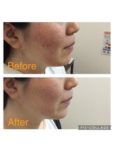 ワイズ 宜野湾鍼灸整骨院/肌荒れと赤み