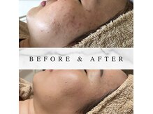 リバージュサロン(RIVAGE salon)の雰囲気（【もうニキビで悩まない】なかなか治らない肌荒れも改善へ）
