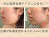 【写真うつりが変わる！】大人気レモンボトル2cc＋高周波フェイシャル60分