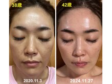 シャイン(shine)/私の経過写真