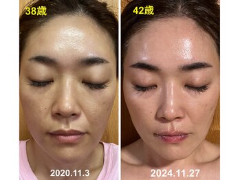 シャイン(shine)/私の経過写真