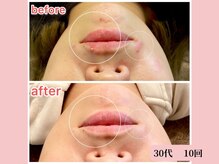 アメリイ 百合ヶ丘 新百合ヶ丘(Amerii)/ハーブピーリング/ニキビ/毛穴