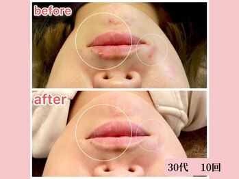 アメリイ 百合ヶ丘 新百合ヶ丘(Amerii)/ハーブピーリング/ニキビ/毛穴