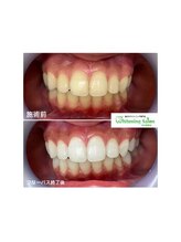 ホワイトニングサロン 名古屋駅店/【ホワイトニング施術例】