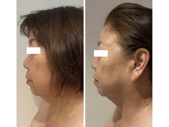 ラディアンス/小顔たるみ特化