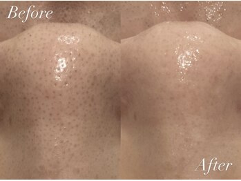 アカヌケ(AKANUKE)/ニキビケアに毛穴洗浄がおすすめ