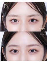 カルス(carus)/HBL　before/after