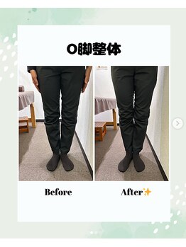 東灘区甲南山手わだち整骨院/O脚改善ビフォーアフター