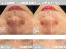 サロン ビュー(salon view)/40代女性〈毛穴黒ずみ悩み〉