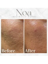 ノア 新宿(Noa) 毛穴 改善