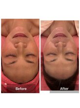 サロンドデュイ/1回施術/40代/ 光フェイシャル