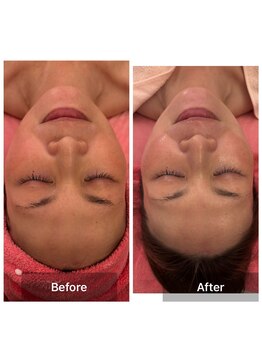 サロンドデュイ/1回施術/40代/ 光フェイシャル