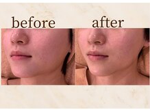 アンバー 恵比寿(AMBER)/小顔リフトアップ×肌質改善