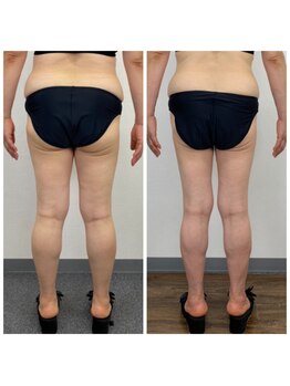 メンズ脱毛 リボーン(reborn)/シークレットメス